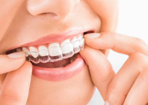 Transparent Teeth Braces in Tirupur| 5d Align